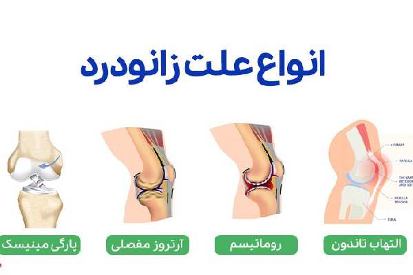 تشخیص دقیق برای درمان زانو درد