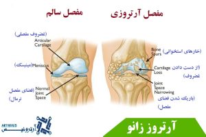 درمان آرتروز زانو