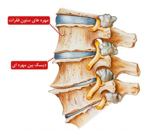 بهترین کمربند طبی برای درمان دیسک کمر